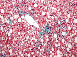 Blobs of fat (white circles) fill up and distort hepatocytes, stained in red, which up bulk of the liver. Cases of fatty liver disease are on the rise in Canada.