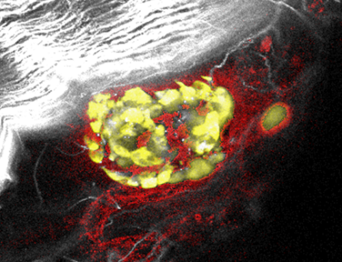 New Medicine by Design-funded research advances an under-skin cell therapy for type 1 diabetes